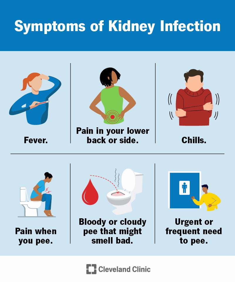 Symptoms of a kidney infection include fever, pain in your lower back or side, chills, pain when you pee, bloody or cloudy pee that might smell bad, and an urgent or frequent need to pee.