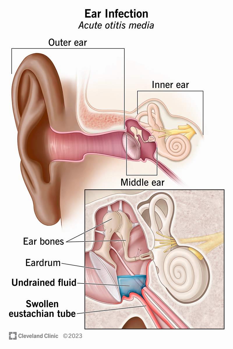 The image shows the anatomy of the ear and the location of an ear infection.