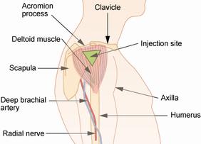 A diagram showing the injection site for the deltoid muscle.