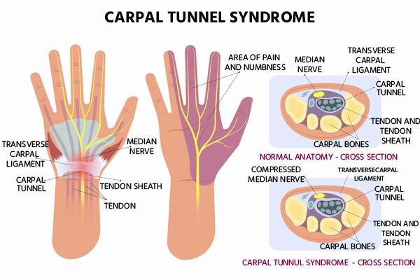 This image displays the anatomy of the carpal tunnel and the median nerve, and how the tendons and median nerve can become compressed in carpal tunnel syndrome.