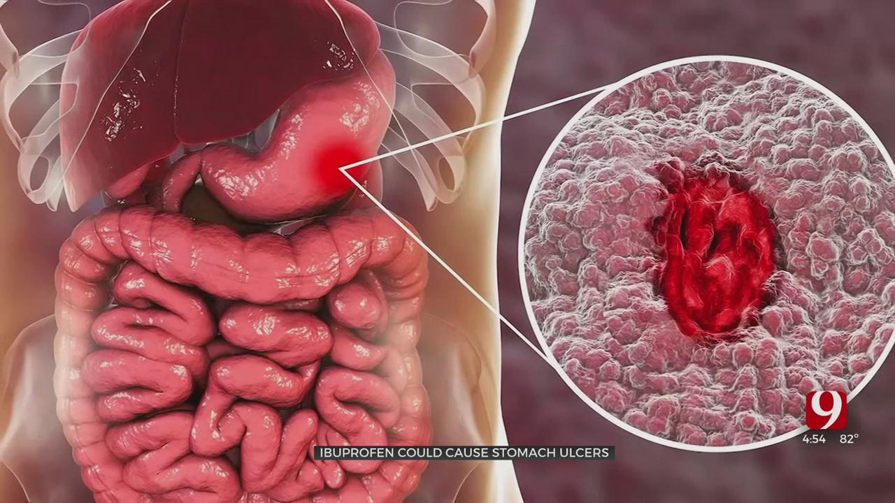 A stomach ulcer is a sore that forms in the lining of the stomach.