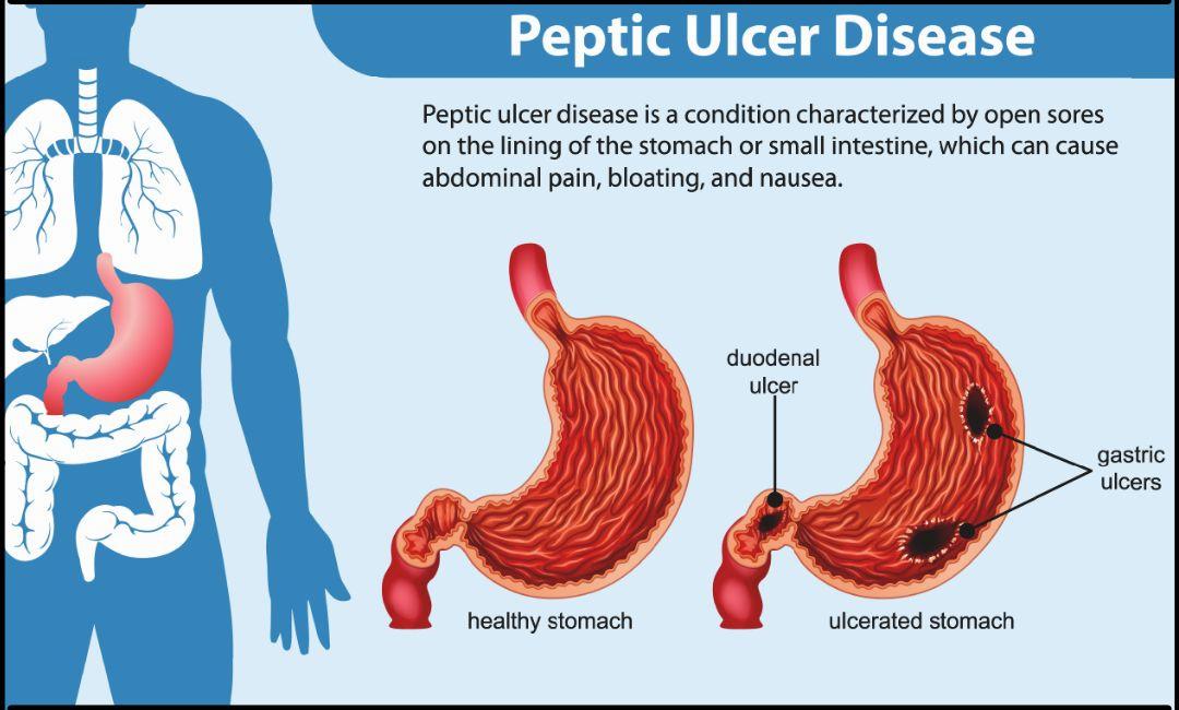 A stomach ulcer is a sore in the lining of the stomach, while a duodenal ulcer is a sore in the lining of the duodenum, the first part of the small intestine.
