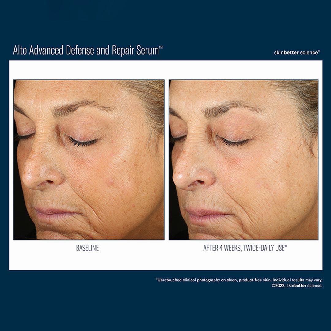 A womans face with wrinkles on the left and smoother skin on the right after four weeks of twice-daily use of Alto Advanced Defense and Repair Serum.