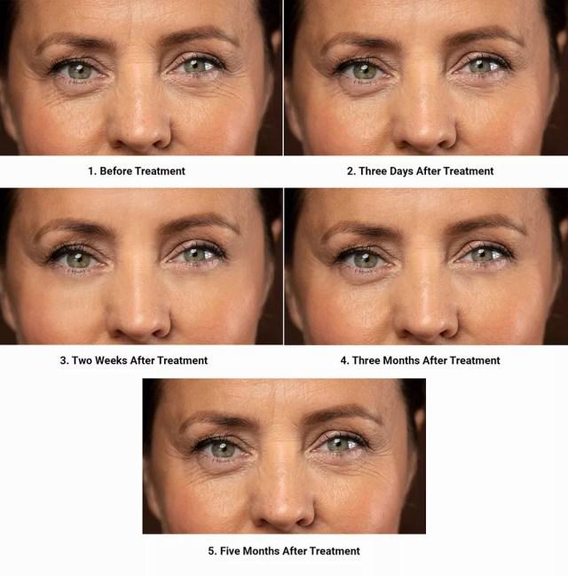 A sequence of five photos shows a womans forehead wrinkles gradually diminishing over a five-month period after receiving treatment.