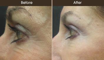 The after image shows reduced signs of crows feet on the outer edge of the eye.