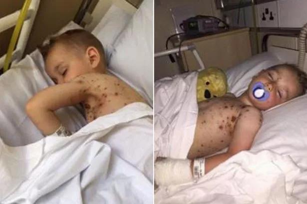 Two photos of a young boy in a hospital bed, the first with a rash all over his body and the second with a pacifier in his mouth and a bandage on his arm.