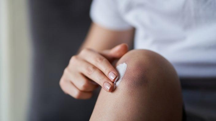 Close-up of woman applying cream on bruised knee.