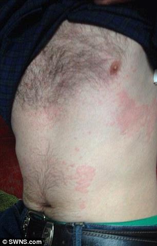A man with a red rash on his abdomen.