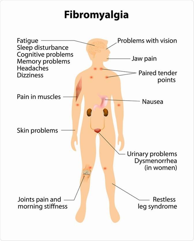 A diagram showing the various symptoms of fibromyalgia.
