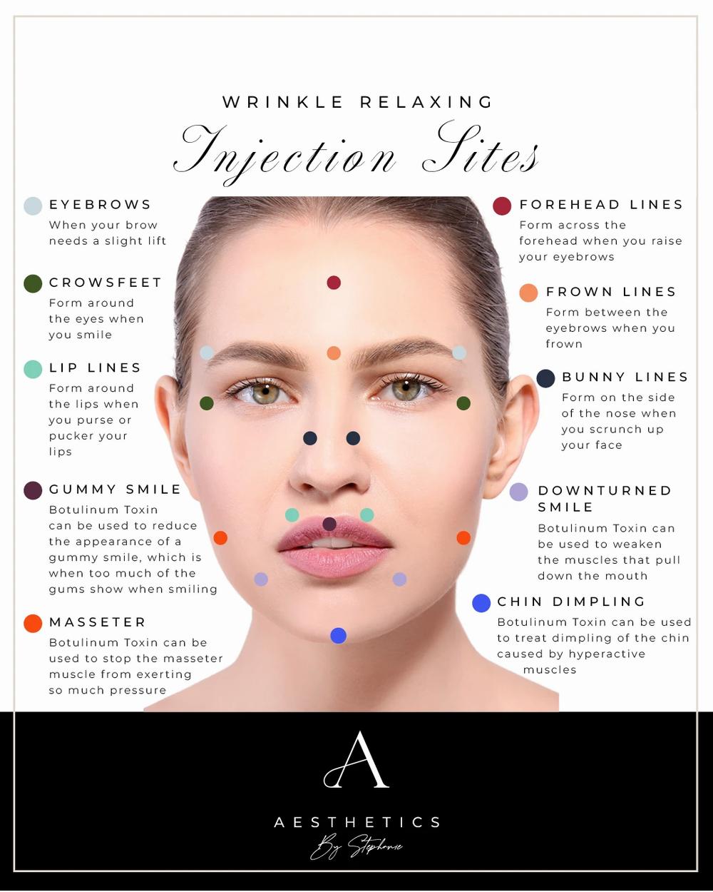 An illustration showing the different areas of the face where injections can be used to relax wrinkles.