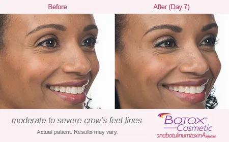 Botox Before and After Crows Feet: A Comprehensive Guide