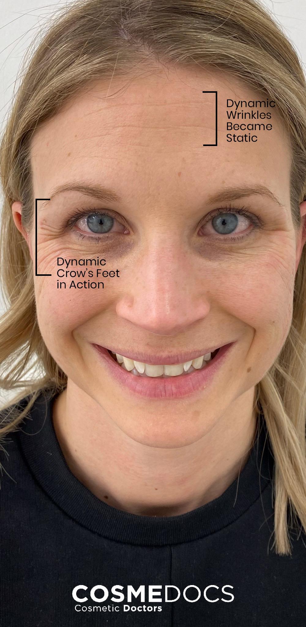 The image shows a womans face with dynamic wrinkles and crows feet.