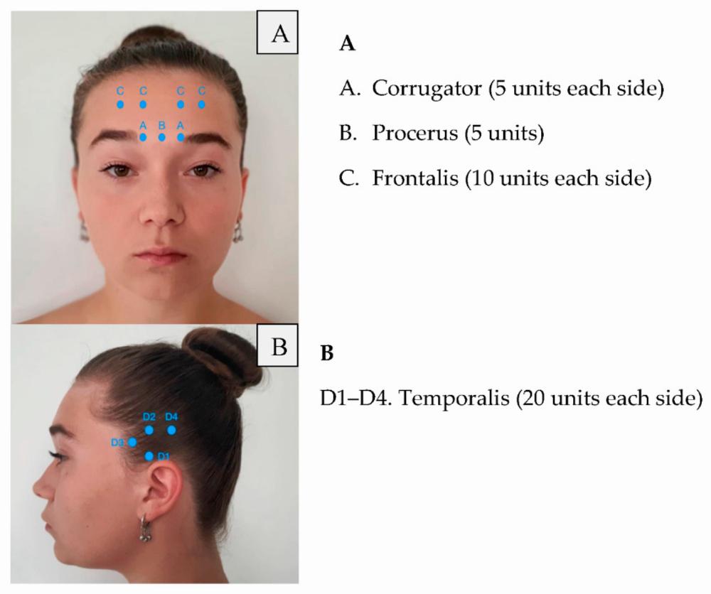 The image shows a woman with dots on her face and head, indicating acupuncture points.