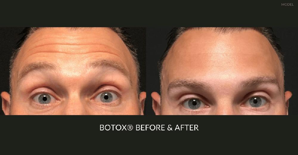 40 Units of Botox Before and After: Transformative Results Revealed!