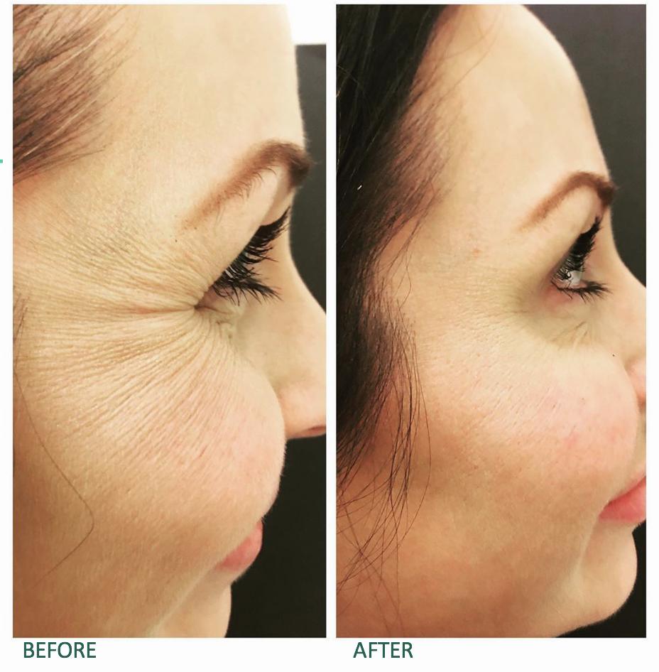 A womans face with crows feet wrinkles before and after treatment.