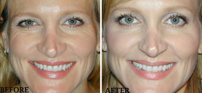 Crows Feet Before and After Botox: A Complete Guide