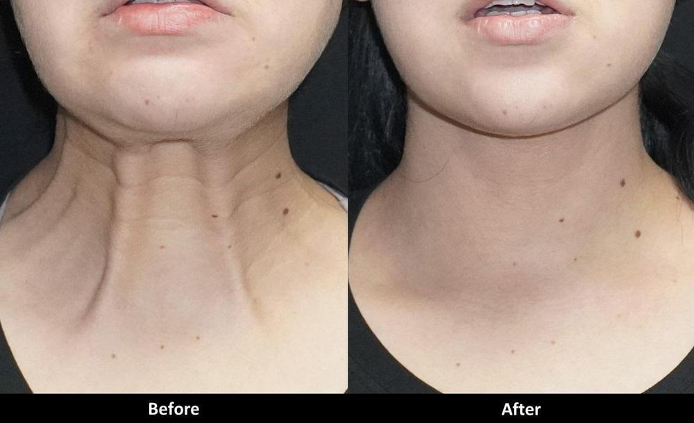 Botox in the Neck Before and After Complete Guide