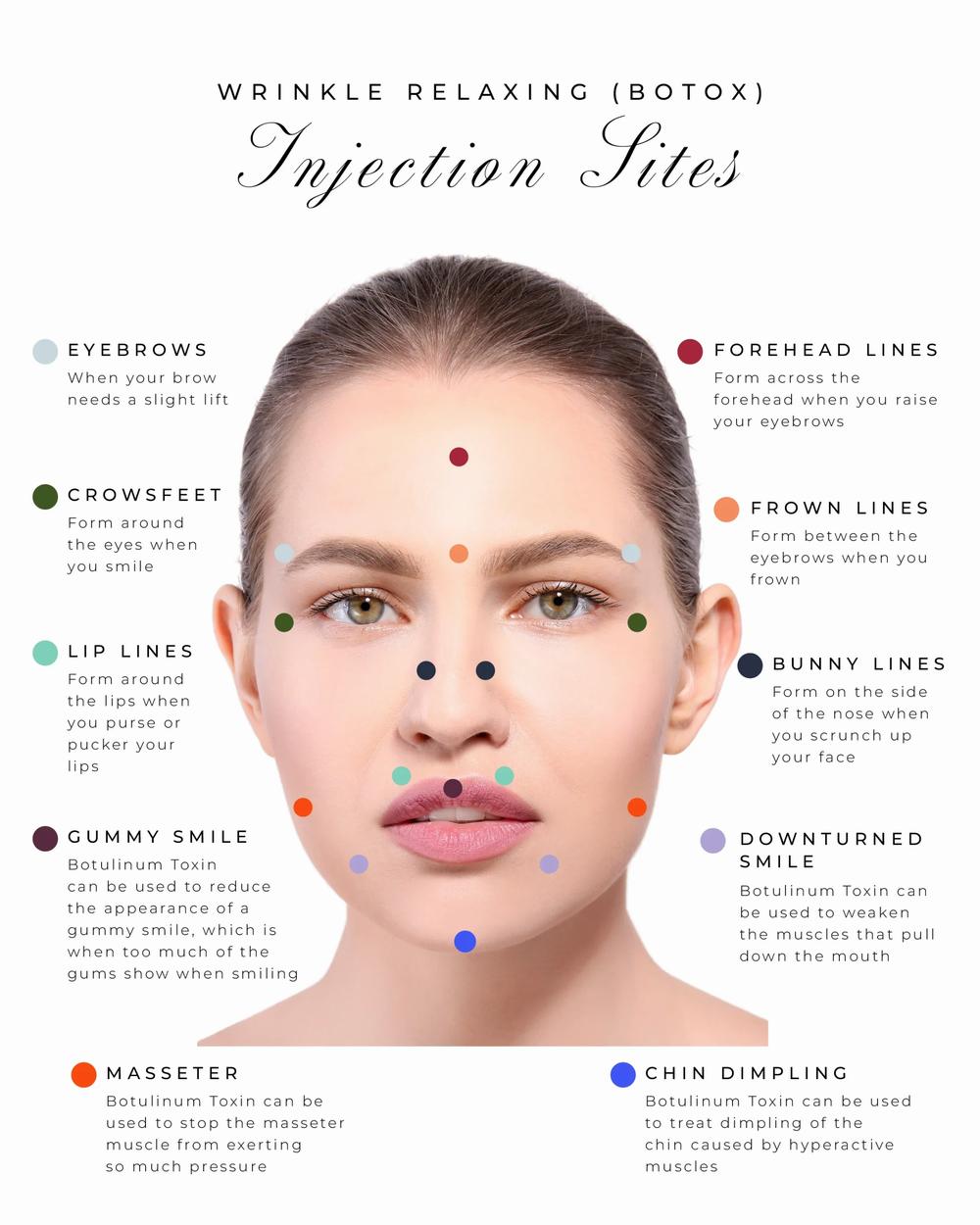 The image is an infographic showing the different injection sites on the face for Botox injections.