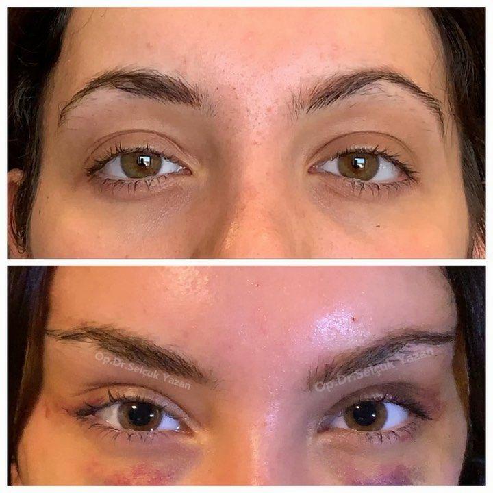 Cat Eye Botox Brow Lift Before And After A Complete Guide