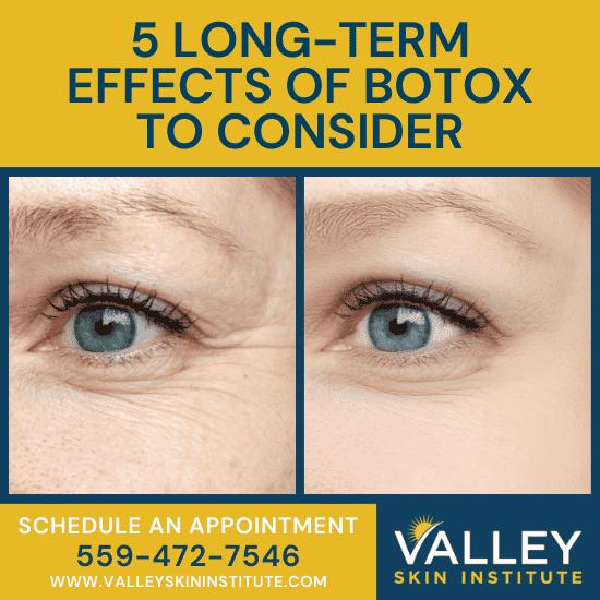A womans face with crows feet on one side and smooth skin on the other side, with text that reads 5 Long-Term Effects of Botox to Consider.