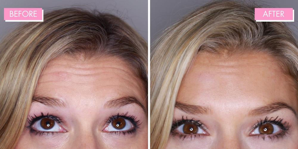 A womans forehead with wrinkles on the left and smooth skin on the right.