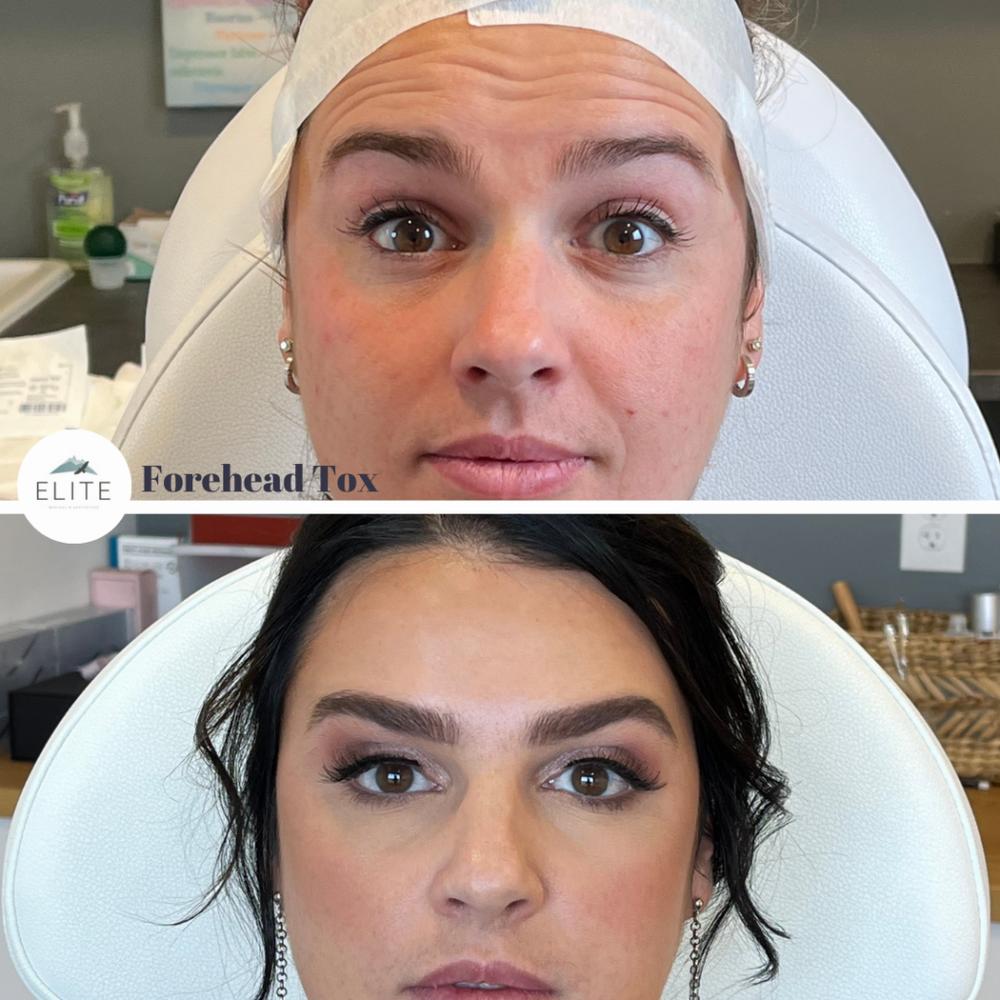 Tracking 7 Day Botox Results Day by Day