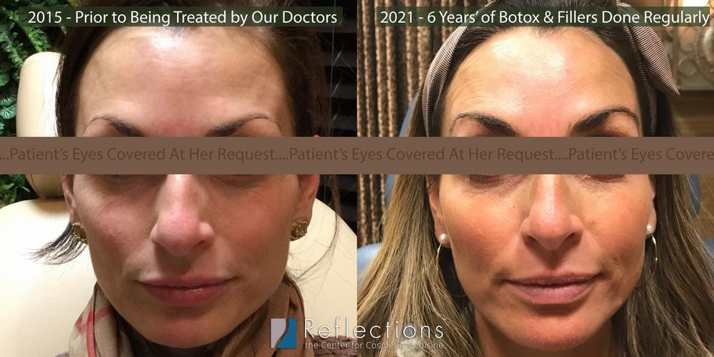 Botox at 50 Before and After: Transformative Effects