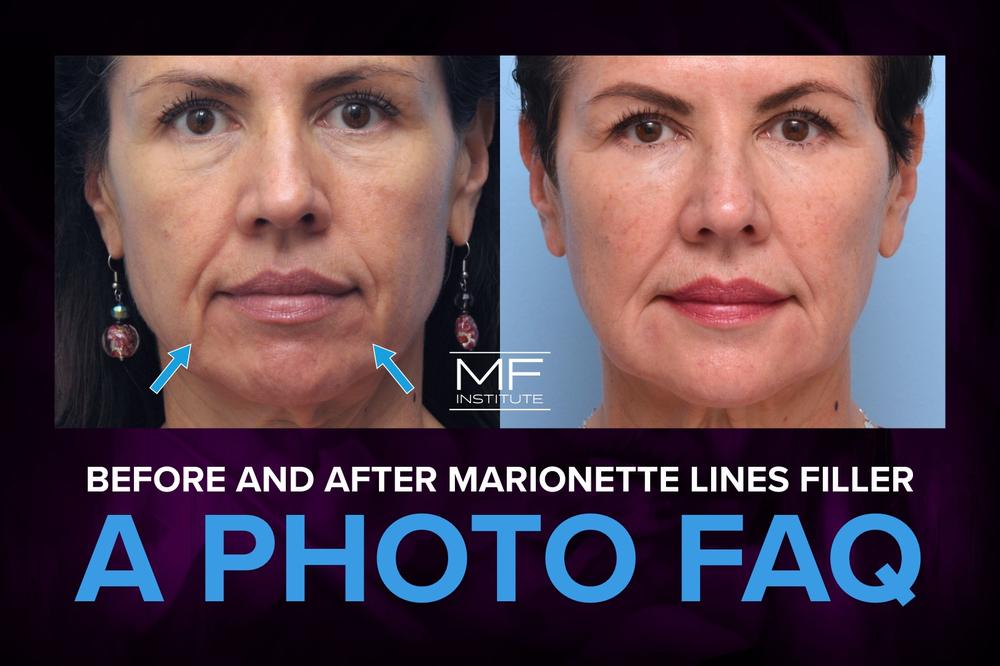 Botox for Marionette Lines Before and After: A Comprehensive Guide