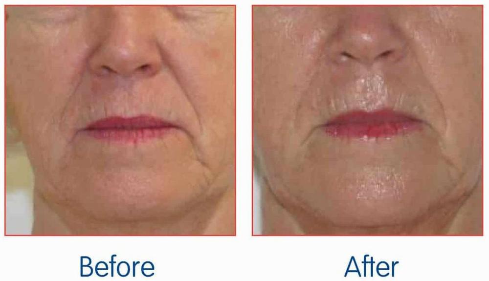 Botox for Marionette Lines Before and After: A Comprehensive Guide