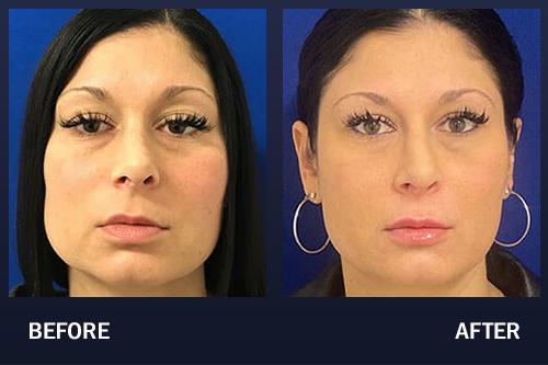 Botox Lower Face Before And After Transformative Results