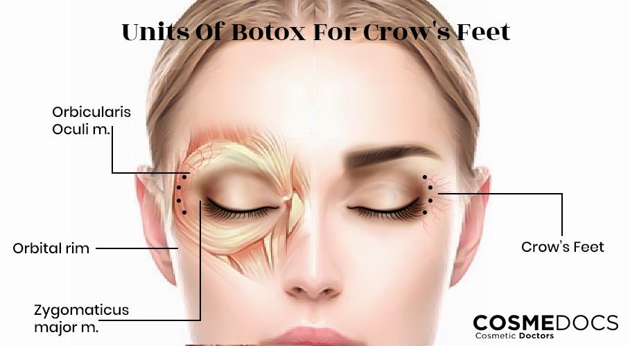 The image displays the muscles around the eye and the injection points for botox to treat crows feet.