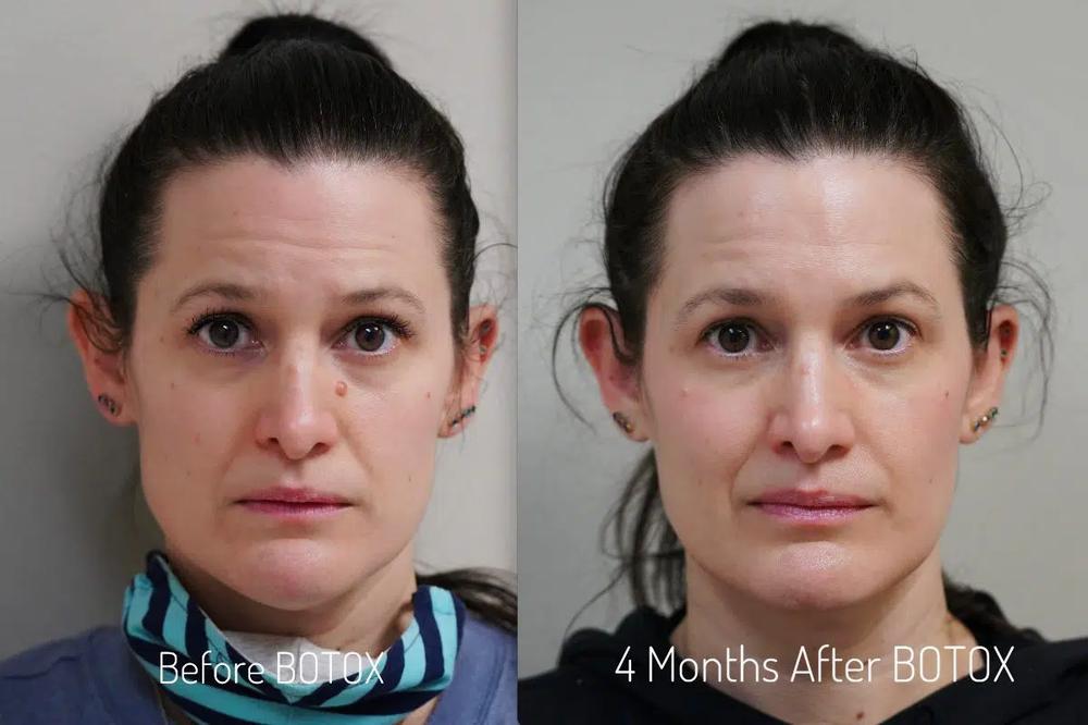 Botox for TMJ Covered by Insurance