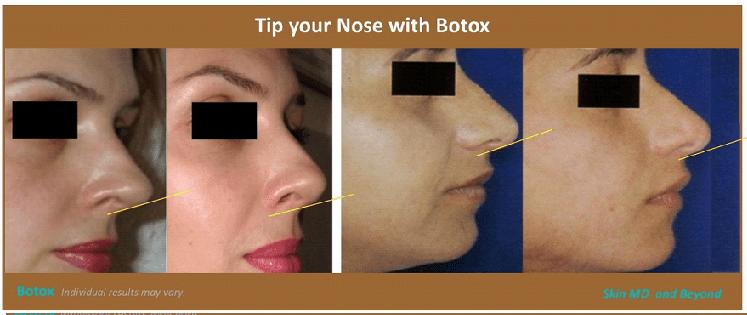 Nasal Flare Botox Before and After: Transform Your Facial Symmetry