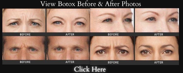 A set of four before and after photos showing the results of Botox injections.