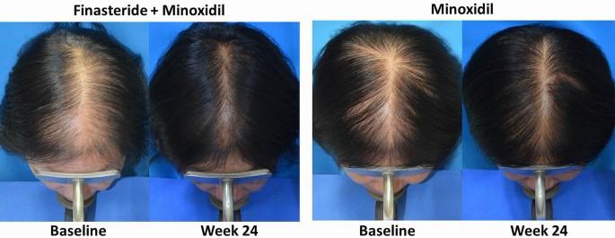A 44-year-old man with androgenetic alopecia at baseline and after 24 weeks of treatment with finasteride and minoxidil.
