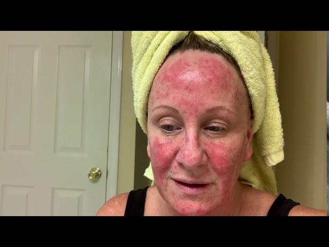 A woman with a red, blotchy face is looking at the camera.
