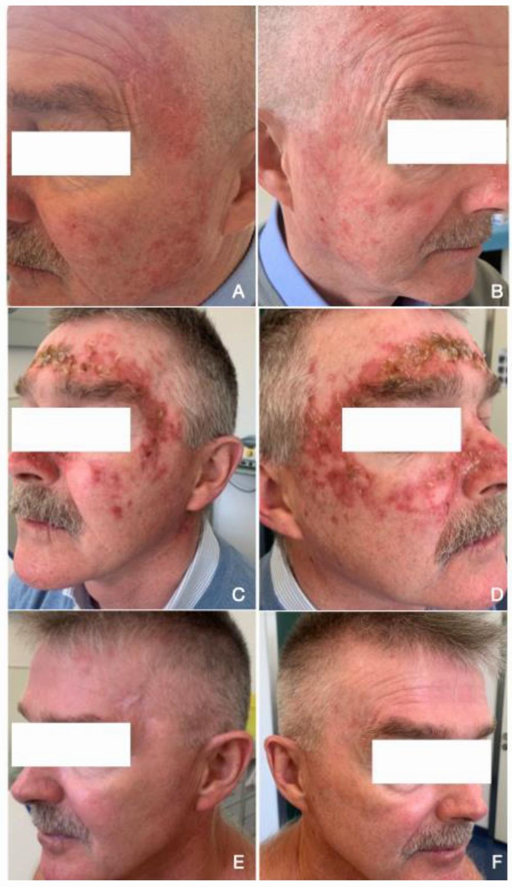 A 64-year-old man with a history of actinic keratosis who presented with multiple erythematous scaly patches on his face.