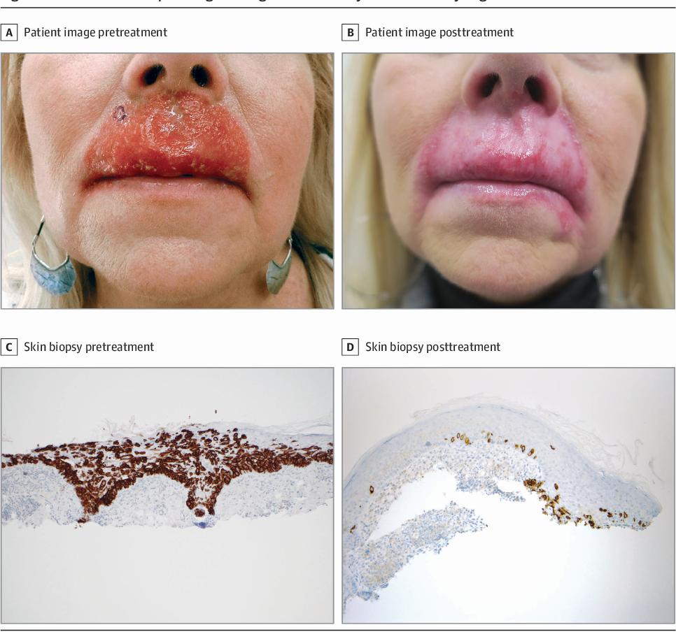 A patient with actinic cheilitis before (left) and after (right) treatment with imiquimod 5% cream. Biopsy of the lesion before (C) and after (D) treatment.