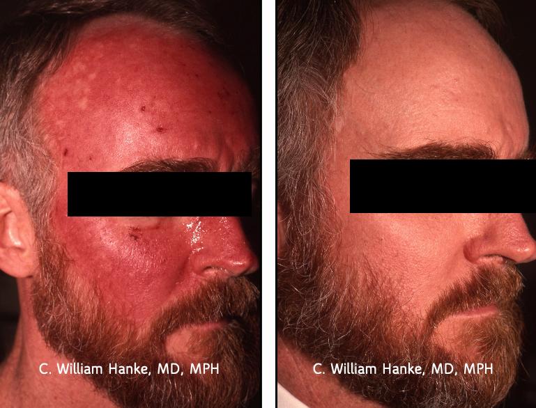 A man with red, blotchy skin on the left and clear skin on the right.