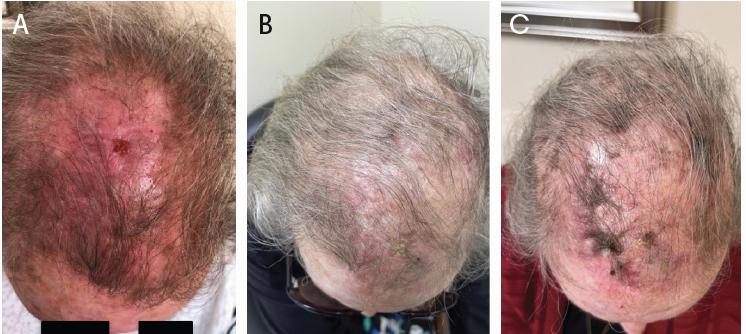 Three images show a man with a large open wound on his scalp in different stages of healing.