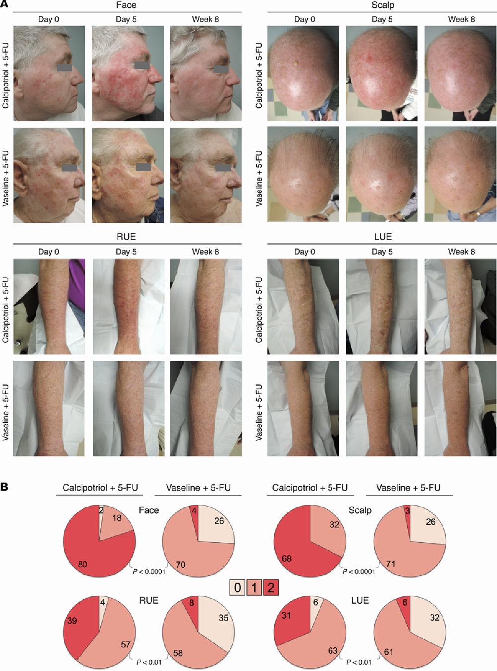 Calcipotriol ointment combined with 5-fluorouracil cream is more effective than Vaseline ointment combined with 5-fluorouracil cream in treating actinic keratosis.