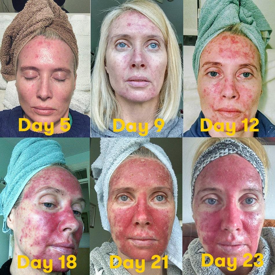 A womans face is shown over six images, with the dates of the photos indicating a three-week period, showing the progression of a chemical peel treatment.