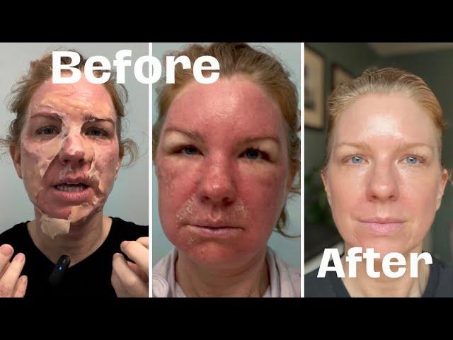 A woman shows the経過 of her skin healing after a chemical peel, with the before picture on the left and the after picture on the right.