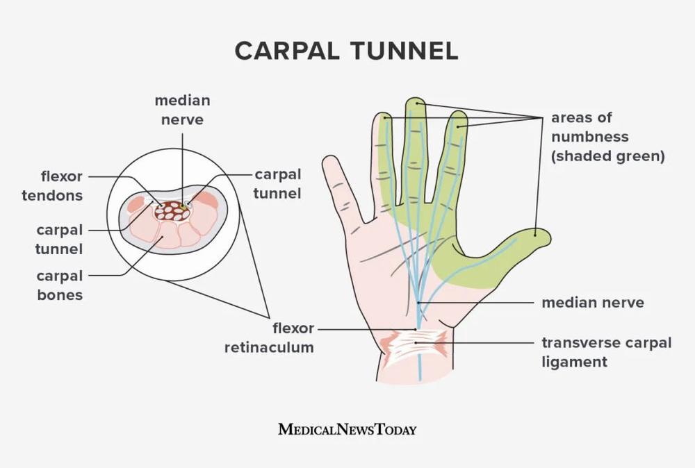 The image shows the anatomy of the carpal tunnel, with the median nerve running through it and the areas of numbness that can occur with carpal tunnel syndrome.