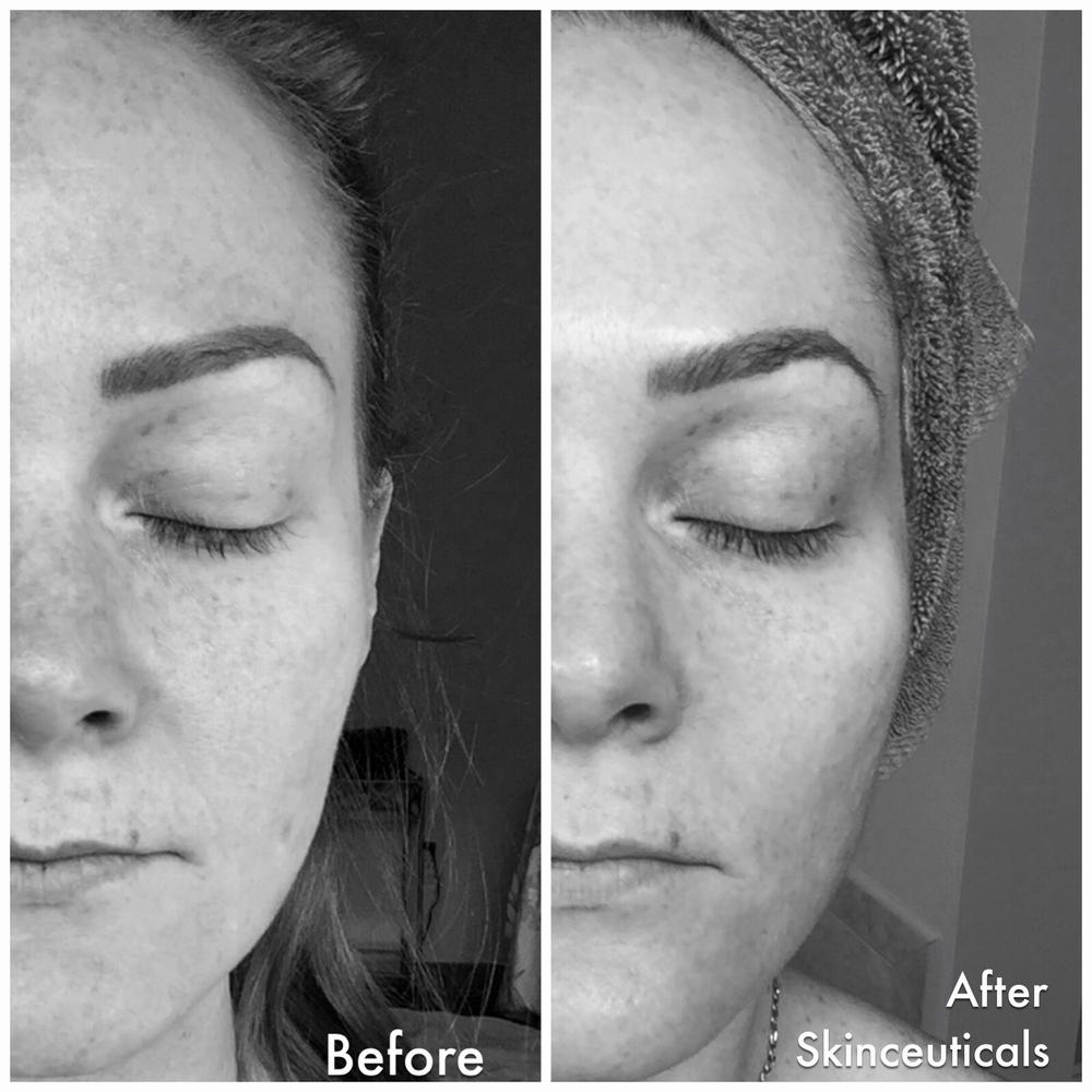 A womans face before and after using SkinCeuticals skincare products.
