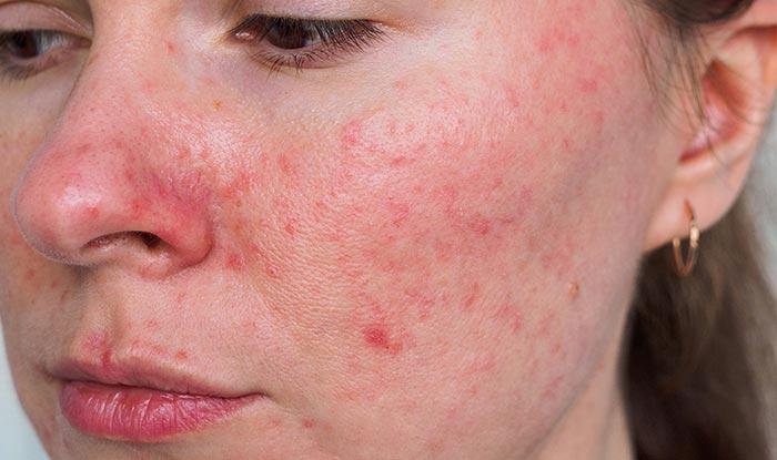 A close-up image of a womans face with red, irritated skin.