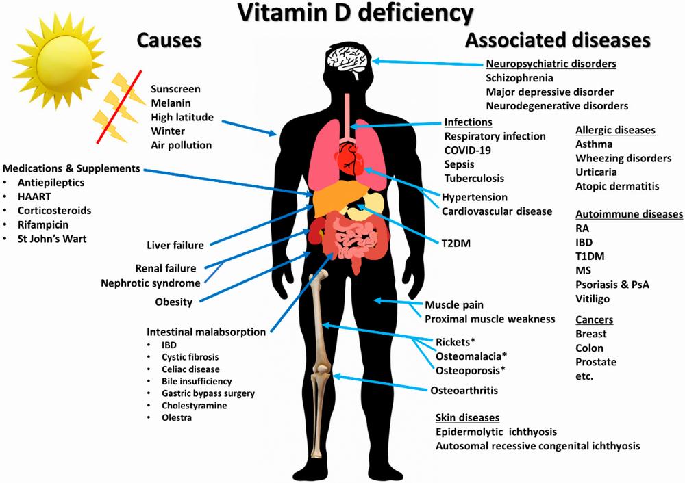 A diagram showing the causes and associated diseases of vitamin D deficiency.