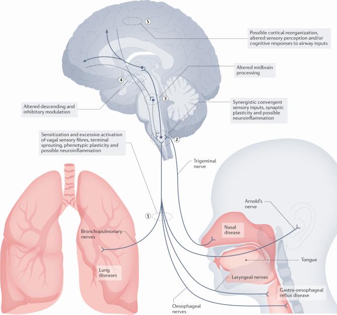 A diagram showing the neural pathways involved in chronic cough.