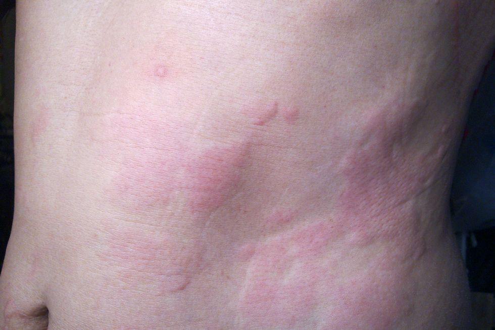 A red, itchy rash on the abdomen.