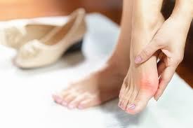 A woman holds her foot in pain, the toes are red and inflamed.